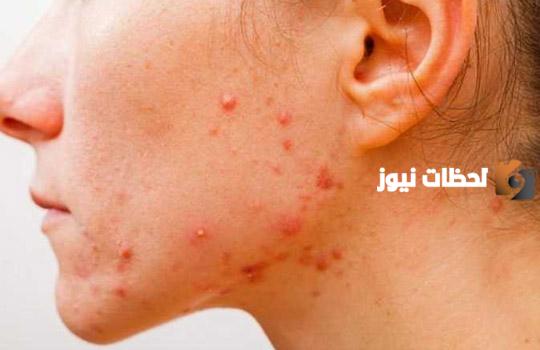 افضل دكتور جلدية بالرياض لعلاج حب الشباب