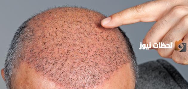 ما حكم زراعة الشعر