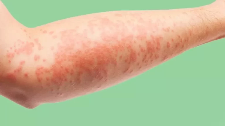 كيف يمكن التعرف على أعراض حساسية حمض الفوليك؟