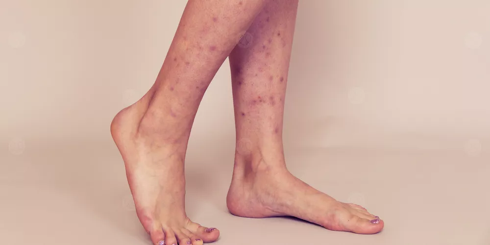 ظهور حبوب حمراء في الرجل مع حكة