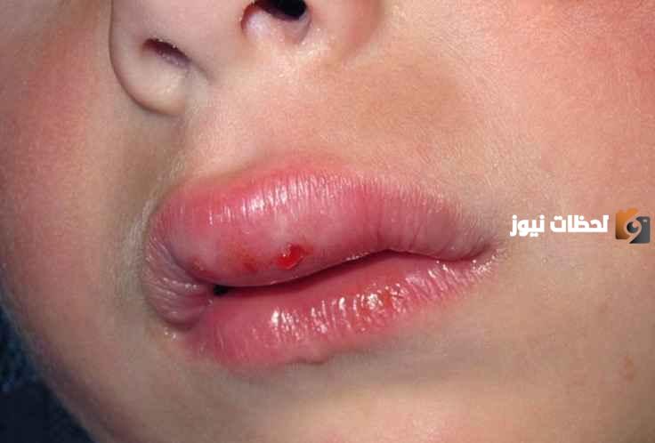 كيف يمكنني التعامل مع تورم الشفاه العليا عند الأطفال بعد السقوط؟