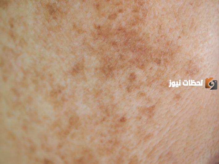 ما سبب ظهور بقع بنية على الساق بدون حكة؟