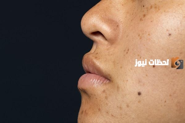 ما علاج البقع البنية بعد إزالة الشعر
