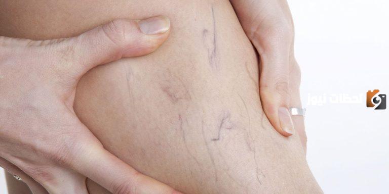 كيفية علاج الدوالي بالاعشاب وأهم طرق الوقاية