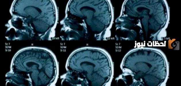 ما هي أعراض ضمور المخ وكيفية علاجه