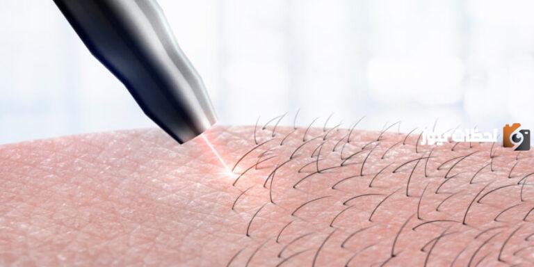 أضرار إزالة الشعر بالليزر