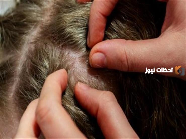 علاج للقمل سريع المفعول
