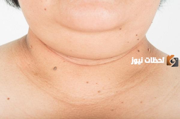 التخلص من دهون الرقبة
