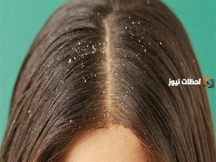 بطرق طبيعية وآمنة بالمنزل .. تخلصي من قشرة الرأس والحكة
