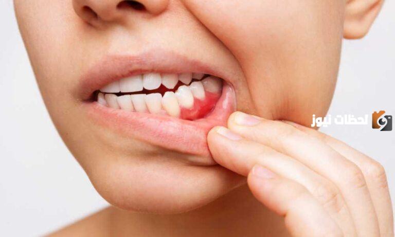 في المنزل بدون الحاجة إلى طبيب .. علاج إلتهاب الأسنان طبيعيًا