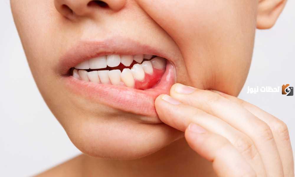 علاج إلتهاب الأسنان طبيعيًا