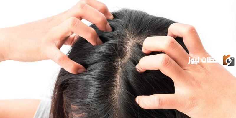 كالخل مع الحنة للتخلص من قشرة فروة الرأس