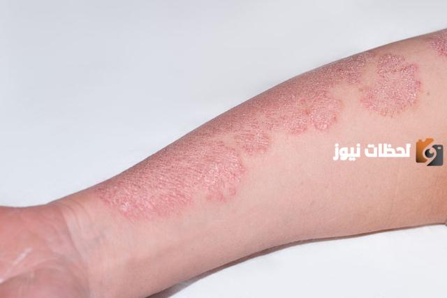 كيف يكون شكل فطريات القطط للإنسان