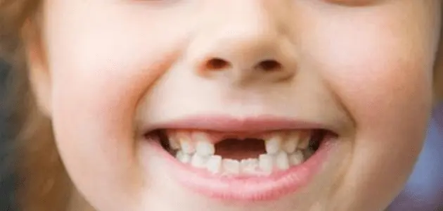 كيفية التعامل مع تسوس الأسنان اللبنية عند الأطفال