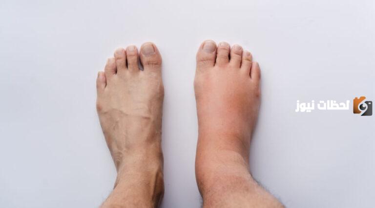 ما سبب انتفاخ القدم اليمنى بدون ألم؟