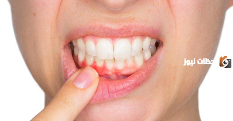 ما هو التهاب اللثة عند الأطفال Gingivostomatitis