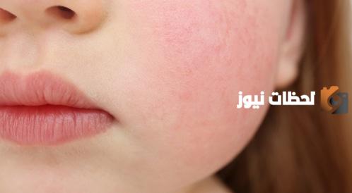 ما هو المرض الخامس لدى الاطفال وما هي أعراضه