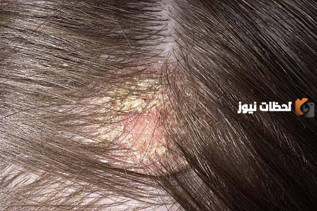 ما هي أسباب قشرة الرأس عند الأطفال – الأسباب والعلاج والعلاجات المنزلية