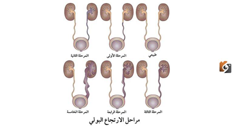 ما هي اضرار الارتجاع البولي المثاني الحالبي عند الأطفال