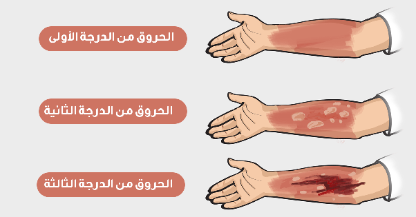 الإسعافات الاولية للكسور والحروق