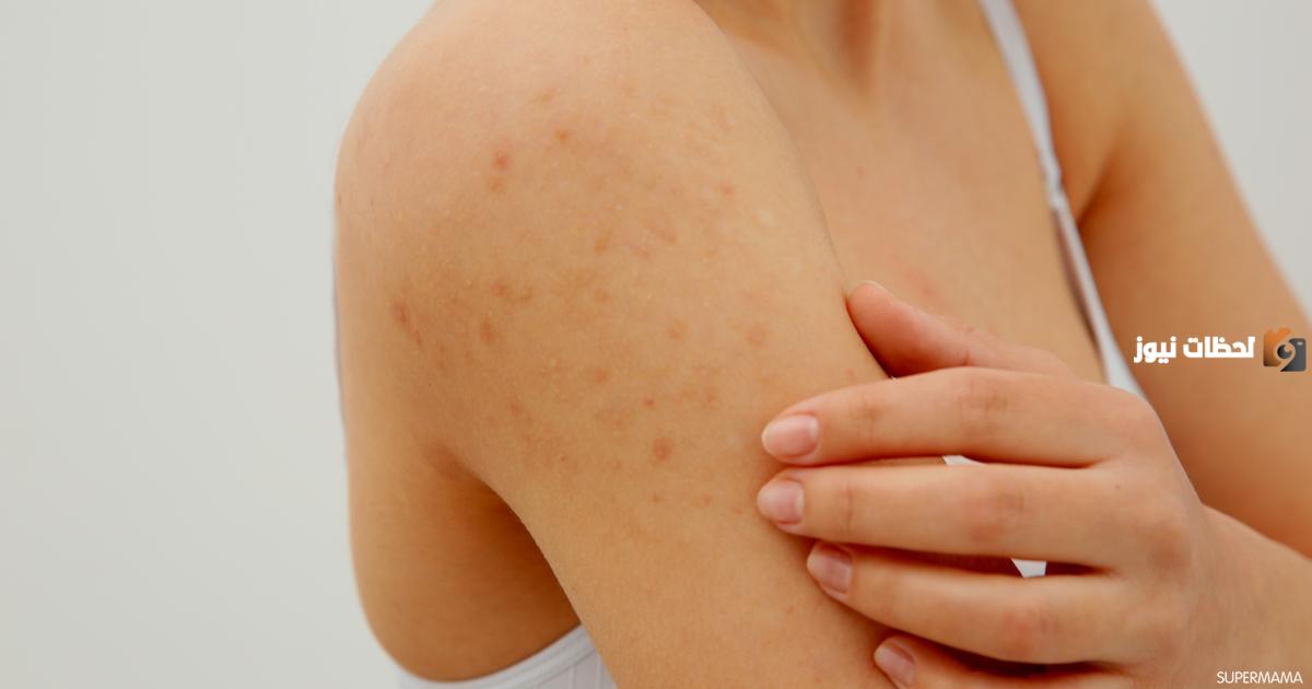 تعرف على طرق علاج أثار الحبوب والبقع في المنطقة الحساسة