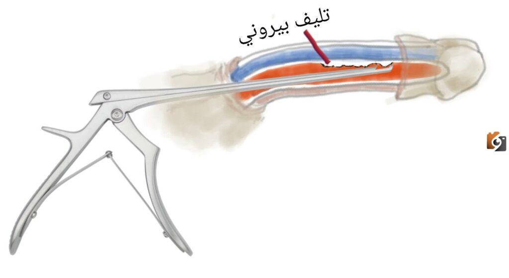 علاج تليف الذكر بالاعشاب