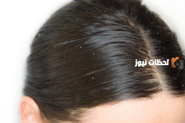 طرق العناية بالشعر الدهني المتساقط
