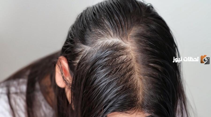 طريقة إنبات الشعر في الفراغات بالثوم