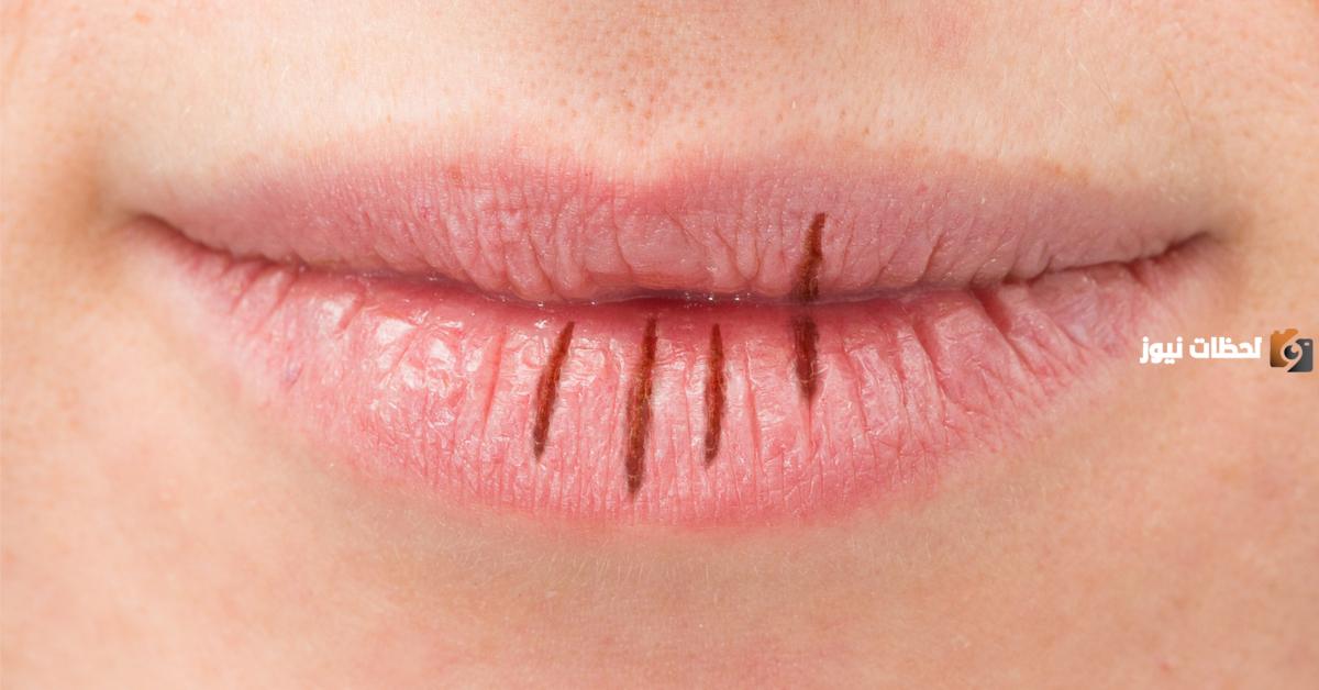 علاج تشقق الشفاه بخلطات طبيعية حديثة (تشققات الشفتين)