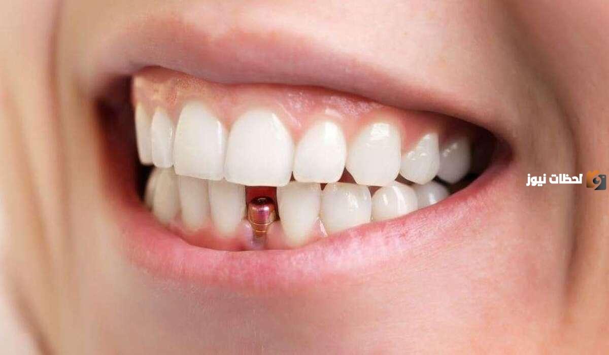 ماذا يغطي تأمين بوبا في عيادة الأسنان وهل يشمل زراعة وتركيب وتقويم وتنظيف الأسنان؟!