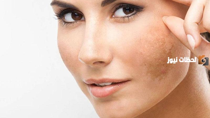 ما هي أفضل خلطات طبيعية لعلاج الكلف
