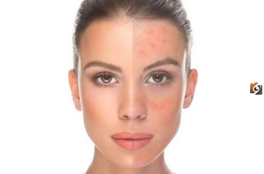 ما هي طرق علاج البشرة الحساسة بالأعشاب