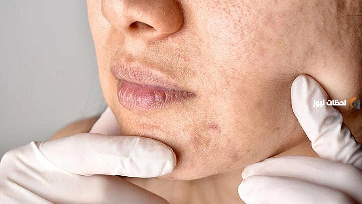 ما هي طرق علاج المسامات المسدودة على الذقن والأنف