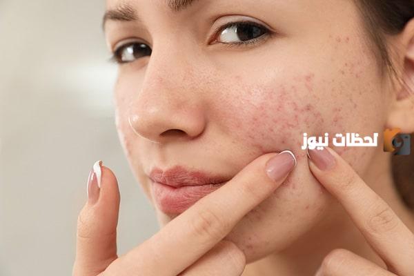 ما هي طرق علاج حب الشباب بأحدث الاساليب