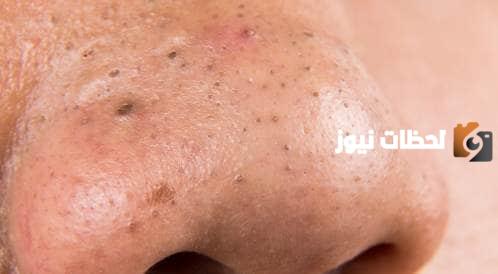 حب الشباب والرؤوس السوداء السعر وطريقة الاستخدام