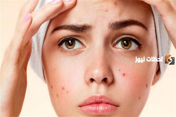 Netlook لعلاج حب الشباب