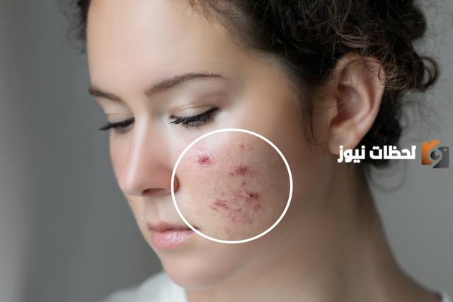 كيفية إزالة آثار حب الشباب