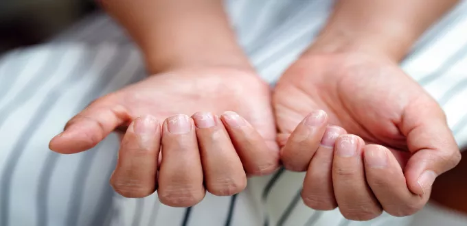 أعراض نقص الحديد للأطفال