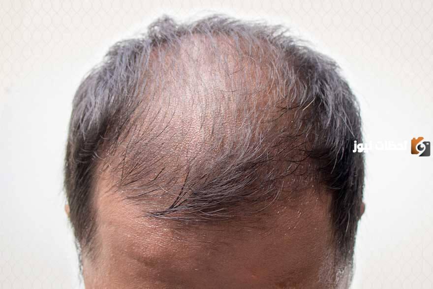 طرق زراعة الشعر بالخلايا الجذعية وتكلفتة وأضرارة
