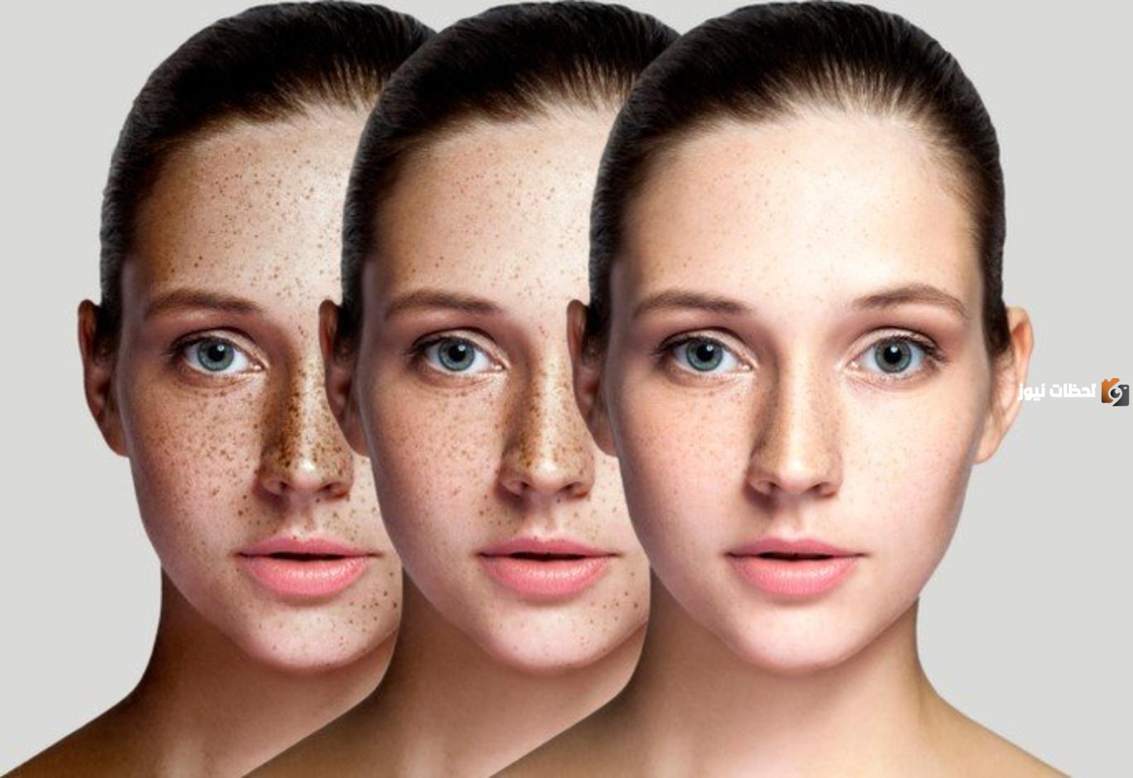 طرق علاج النمش في الوجه طبيعياً وأسباب ظهورة