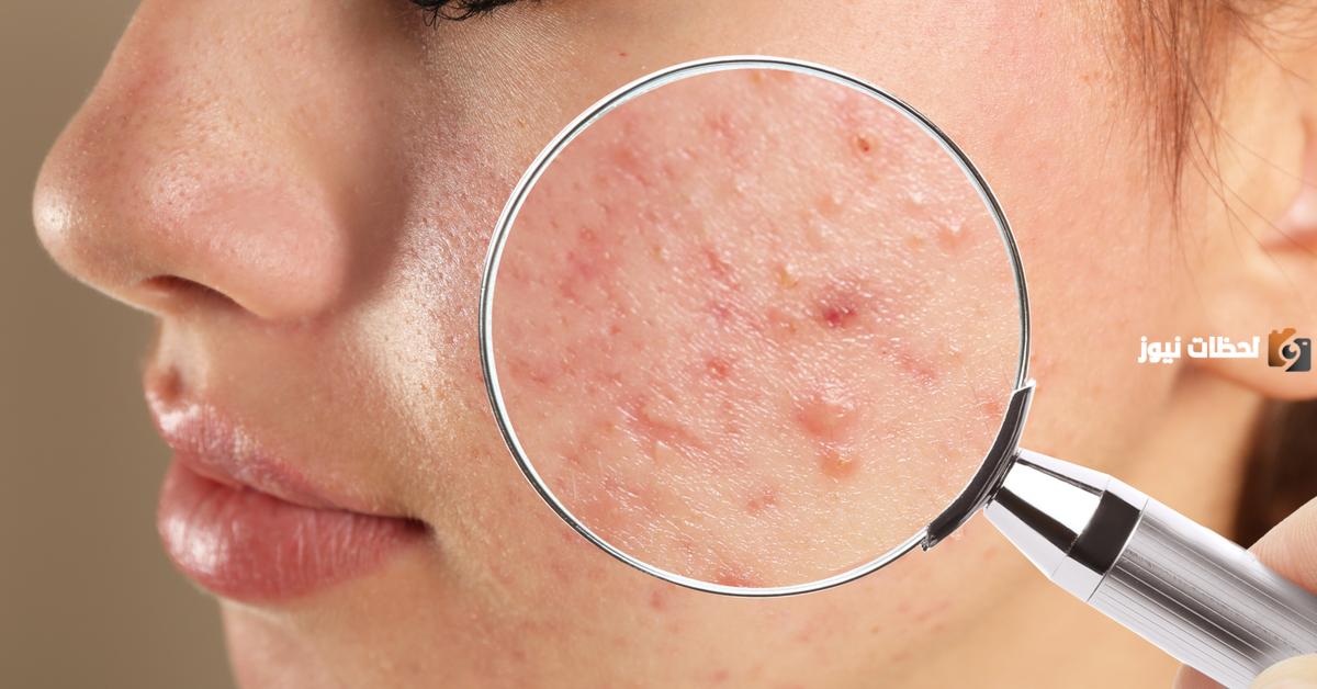 طرق علاج حب الشباب طبيعية 