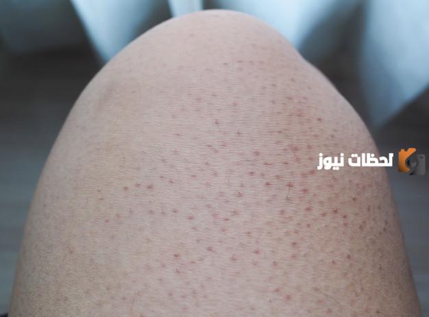 المسامات في الساقين