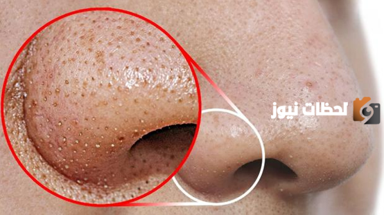 علاج الرؤوس السوداء