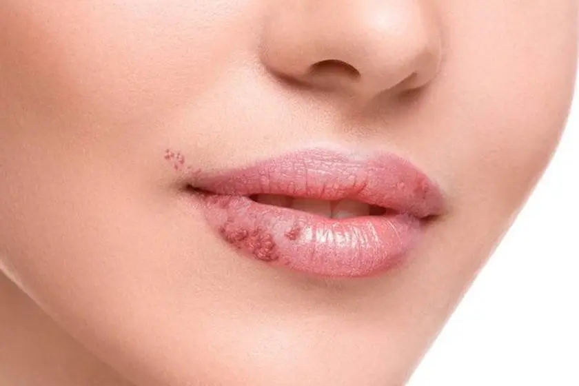 أسباب ظهور لطمة الحمى