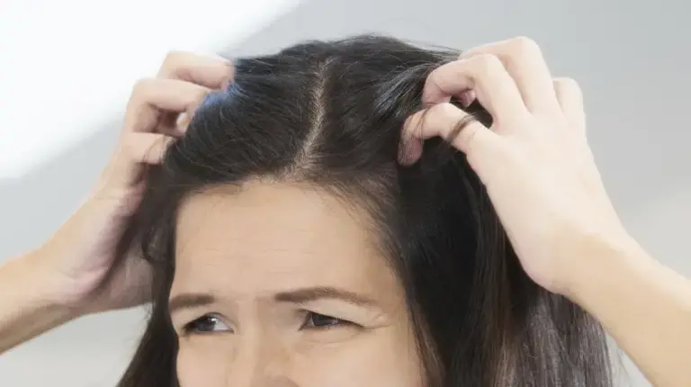 كيف يتم إزالة القشرة من الشعر بالليمون