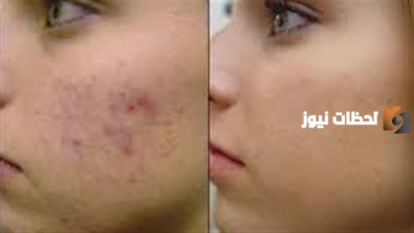 ما هو افضل كريم طبي لإزالة حب الشباب وآثاره