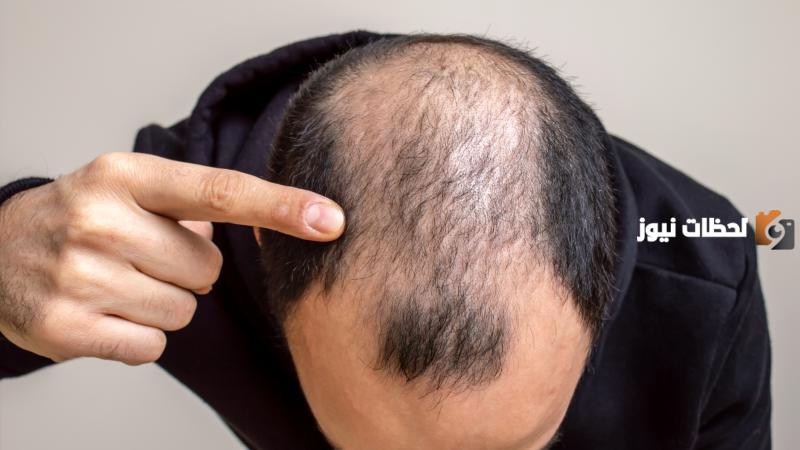 ما هي أسباب تساقط الشعر بكثرة