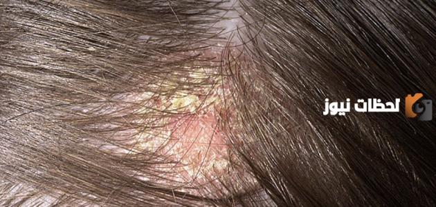 تعرف على اسباب فطريات الشعر عند الاطفال وعلاجها وطرق الوقاية
