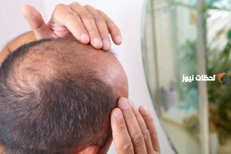 ما هى طريقة علاج صلع الشعر من الجانبين
