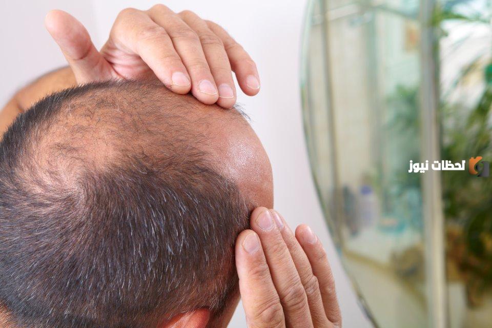 ما هى طريقة علاج صلع الشعر من الجانبين